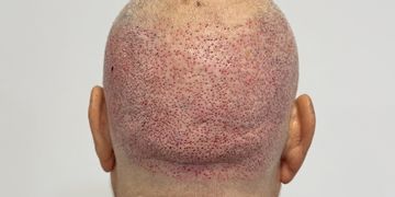 Postoperatorio del trasplante capilar: guía día a día y mes a mes (Método Capilaris) Postoperatorio del trasplante capilar: guía día a día y mes a mes (Método Capilaris)