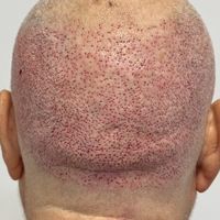 Postoperatorio del trasplante capilar: guía día a día y mes a mes (Método Capilaris)