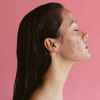 Tratamientos que sí funcionan para el acné hormonal