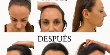Las consultas por caída del pelo en mujeres se disparan en España: causas reales y qué funciona Las consultas por caída del pelo en mujeres se disparan en España: causas reales y qué funciona