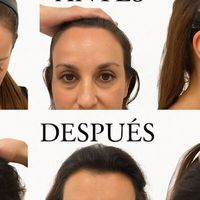 Las consultas por caída del pelo en mujeres se disparan en España: causas reales y qué funciona Las consultas por caída del pelo en mujeres se disparan en España: causas reales y qué funciona