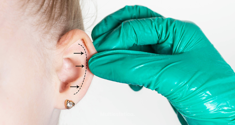 Otoplastia: una corrección discreta que libera la mirada sobre uno mismo.