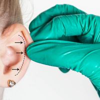 Otoplastia: una corrección discreta que libera la mirada sobre uno mismo.