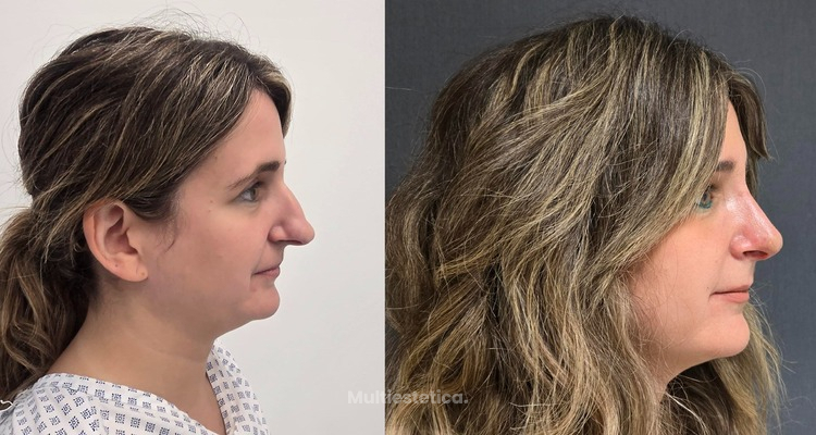 Rinoplastia: cambiar la forma sin perder identidad ni respiración.