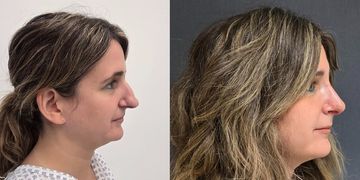 Rinoplastia: cambiar la forma sin perder identidad ni respiración. Rinoplastia: cambiar la forma sin perder identidad ni respiración.