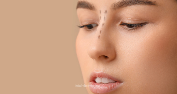 Rinoplastia: Todo lo que necesitas saber antes de transformar tu nariz