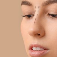 Rinoplastia: Todo lo que necesitas saber antes de transformar tu nariz