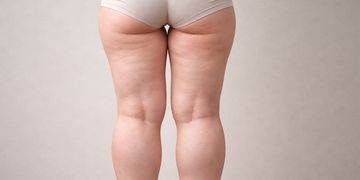 Lipedema: el camino hacia una vida sin dolor ni frustración Lipedema: el camino hacia una vida sin dolor ni frustración