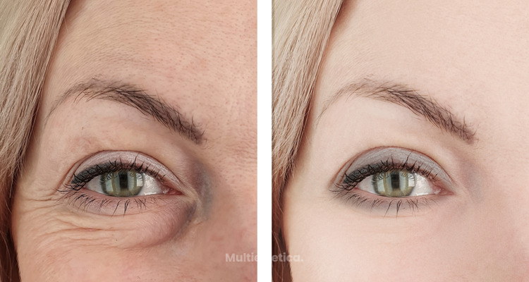 Blefaroplastia moderna: