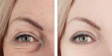 Blefaroplastia moderna: