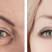 Blefaroplastia moderna: