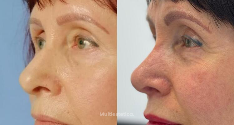 Rinoplastia secundaria: el arte de corregir y restaurar la armonía facial