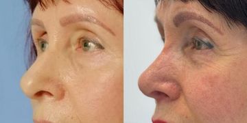 Rinoplastia secundaria: el arte de corregir y restaurar la armonía facial Rinoplastia secundaria: el arte de corregir y restaurar la armonía facial