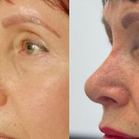 Rinoplastia secundaria: el arte de corregir y restaurar la armonía facial