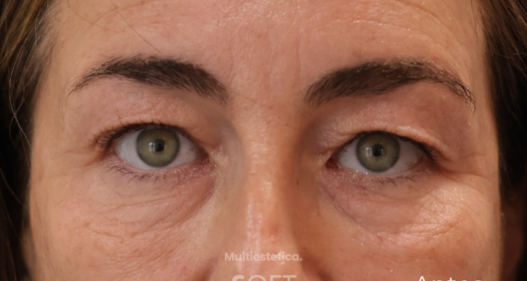 Blefaroplastia en Clínica Soft