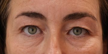 Blefaroplastia en Clínica Soft Blefaroplastia en Clínica Soft
