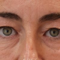 Blefaroplastia en Clínica Soft