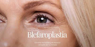Blefaroplastia: ¿Cuánto tiempo necesitarás para volver a tu vida habitual? Blefaroplastia: ¿Cuánto tiempo necesitarás para volver a tu vida habitual?