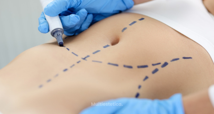 Abdominoplastia: mucho más que eliminar piel del abdomen.