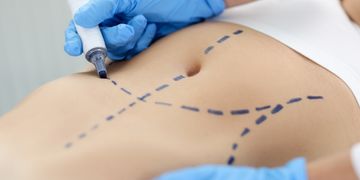Abdominoplastia: mucho más que eliminar piel del abdomen. Abdominoplastia: mucho más que eliminar piel del abdomen.