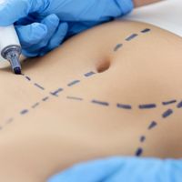 Abdominoplastia: mucho más que eliminar piel del abdomen.