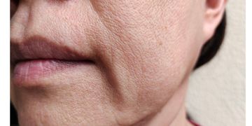 Flacidez y pérdida de volumen facial: por qué aparecen y qué tratamientos pueden mejorar cada problema Flacidez y pérdida de volumen facial: por qué aparecen y qué tratamientos pueden mejorar cada problema