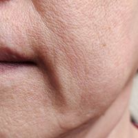 Flacidez y pérdida de volumen facial: por qué aparecen y qué tratamientos pueden mejorar cada problema