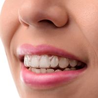 ¿Qué es el sistema de ortodoncia invisible Invisalign?