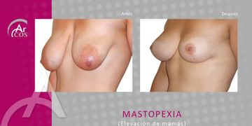 Todo sobre la mastopexia: el verdadero push up del seno