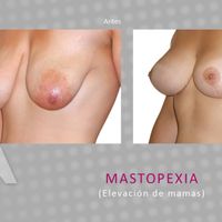 Todo sobre la mastopexia: el verdadero push up del seno
