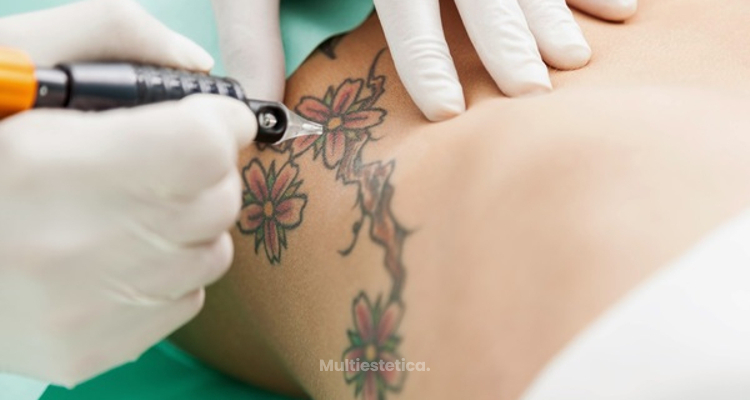 Skinial, la eliminación de tatuajes sin láser