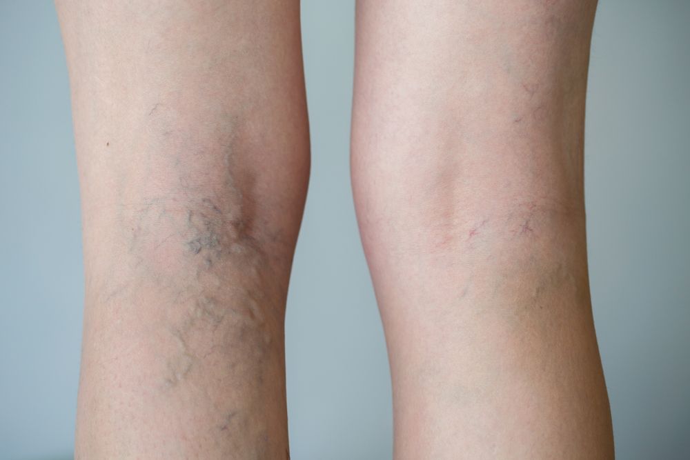 Laser para varices efectos secundarios