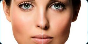 rinoplastia.png