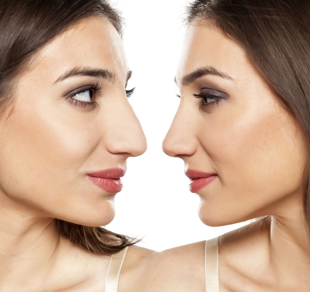 rinoplastia-3.jpg