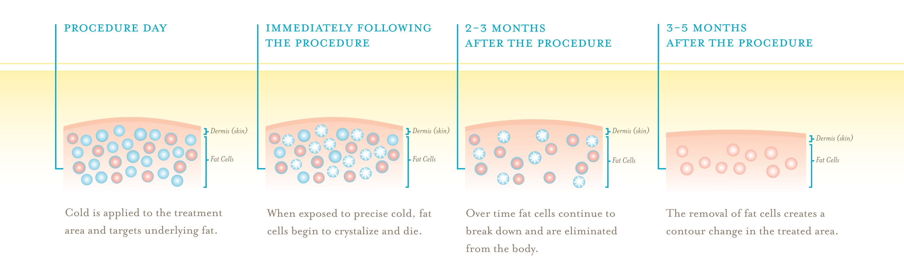 coolsculpting-illustration.jpg
