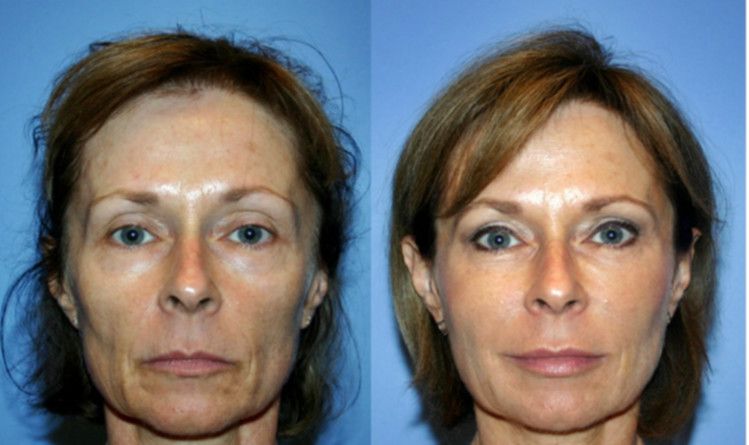 ojeras-1.jpg