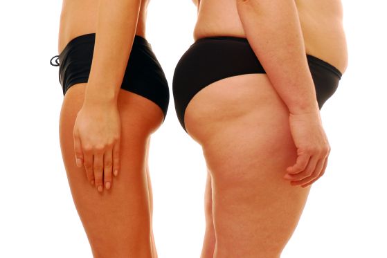 gluteoplastia2.png