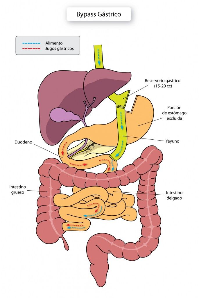 bypass-gastrico-esquema-685x1024.jpg