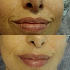 Tratamiento de arrugas labios - Reina Paz Estética Avanzada