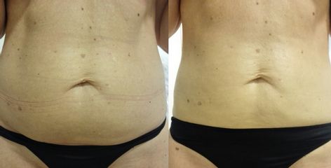 Tratamiento adiposidad abdomen - Reina Paz Estética Avanzada