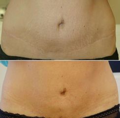 Microblading - Reina Paz Estética Avanzada