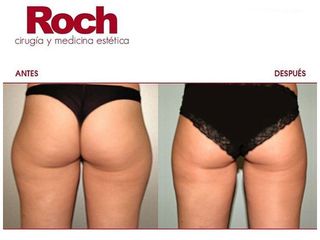 Antes y después Lipo Vaser - Clínica Roch