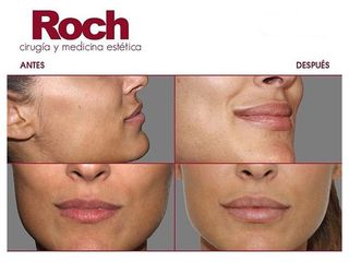 Antes y después Aumento de labios - Clínica Roch
