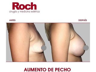 Antes y después Aumento de pecho - Clínica Roch
