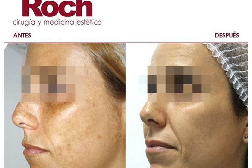 Radiofrecuencia facial antes y después - 702117