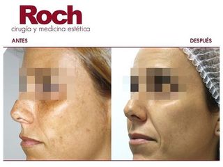 Antes y después Radiofrecuencia facial - Clínica Roch