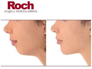 Antes y después Liposucción - Clínica Roch