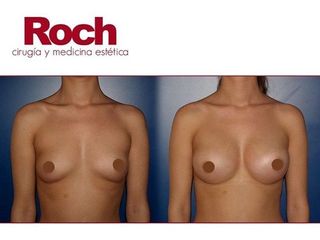 Antes y después Aumento de pecho - Clínica Roch