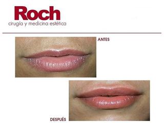 Antes y después Aumento de labios - Clínica Roch