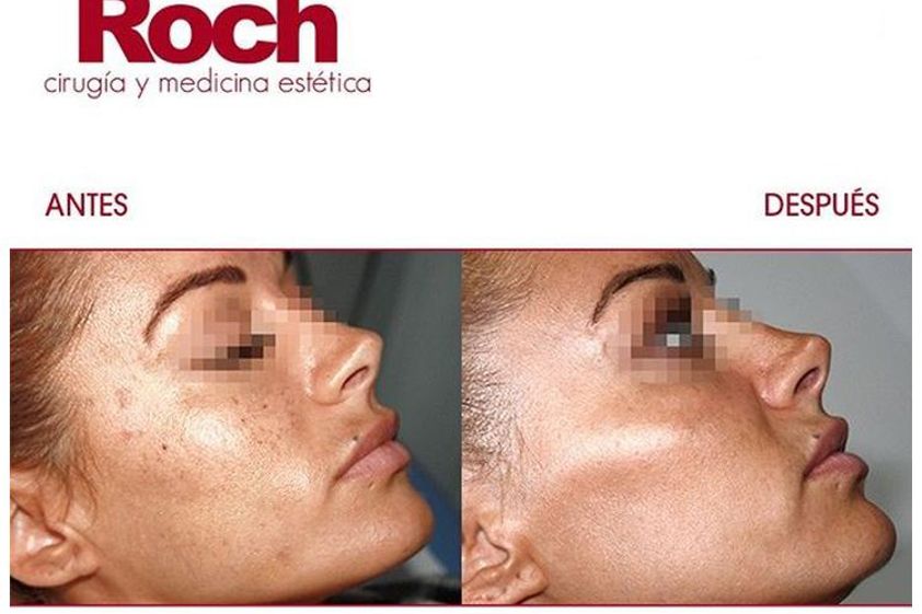 Radiofrecuencia facial antes y después - 702125